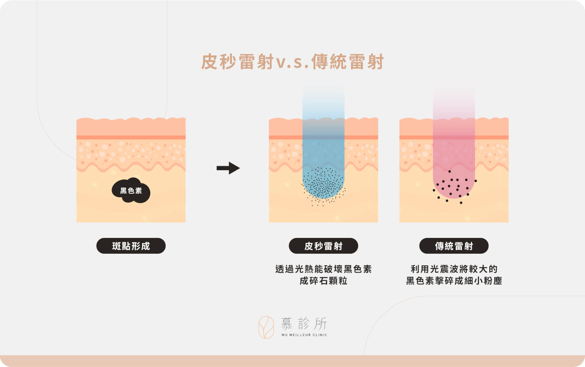 皮秒怎麼選？全新肌膚雷射攻略｜慕診所｜皮秒雷射